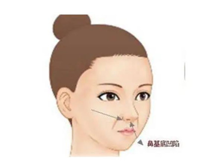 鼻基底對面部的影響大嗎