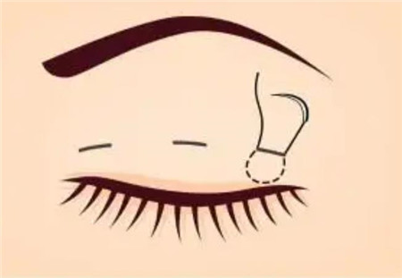 雙眼皮手術(shù)的方法有哪些?