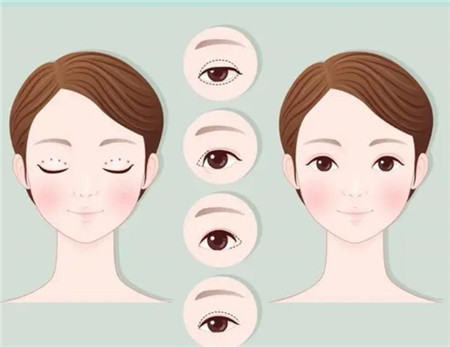 雙眼皮手術(shù)后效果能維持多久?