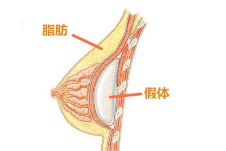 假體隆胸手術(shù)有哪些適應(yīng)癥?