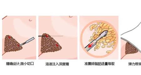 吸脂越多越好嗎?可以幫助減肥嗎