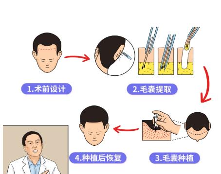 哈爾濱科發(fā)源植發(fā)醫(yī)院植發(fā)怎么樣?植發(fā)是什么的體驗(yàn)？分享網(wǎng)友植發(fā)手術(shù)過程