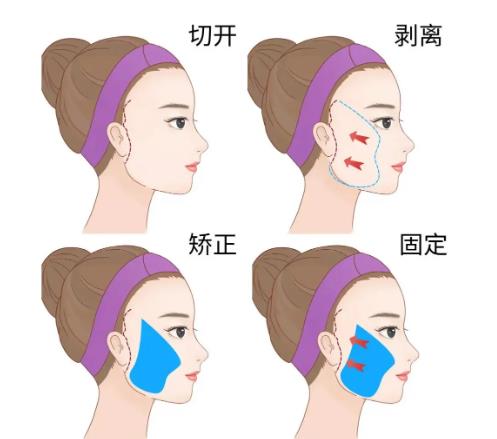 北京301醫(yī)院拉皮手術(shù)好嗎？拉皮手術(shù)案例:皮膚緊致有彈性！內(nèi)含價格表
