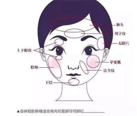 自體脂肪填充面部有什么特點(diǎn)?