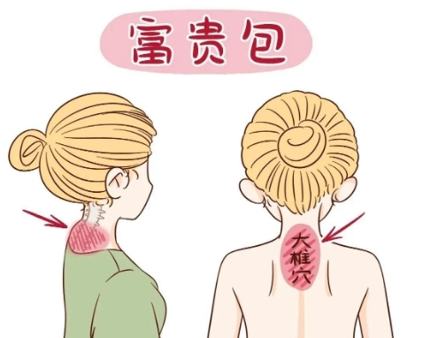 有什么方法可以快速消除富貴包呢