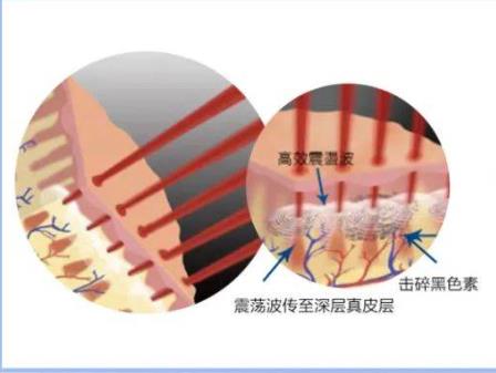 什么是超皮秒激光?有什么作用