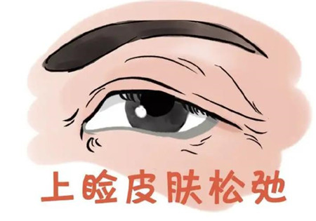 雙眼皮什么情況下需要修復(fù)?