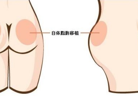 自體脂肪豐臀效果能維持多久?會(huì)導(dǎo)致臀部下垂嗎
