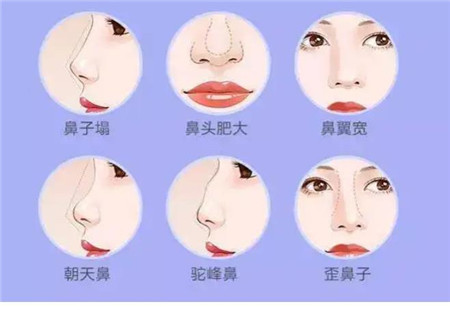 填充鼻基底切口在哪里，要注意哪些事項