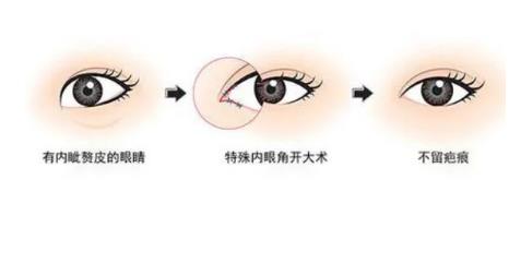 眼皮吸脂術有哪些優(yōu)點，效果如何