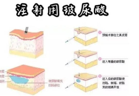 玻尿酸填充臥蠶消腫需要多長(zhǎng)時(shí)間