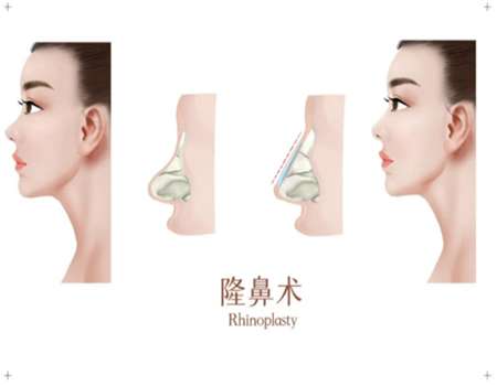 自體耳軟骨隆鼻價(jià)格多少？隆鼻的注意事項(xiàng)查看