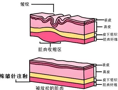 小拉皮和線雕哪個好？線雕反復(fù)做可以代替小拉皮嗎