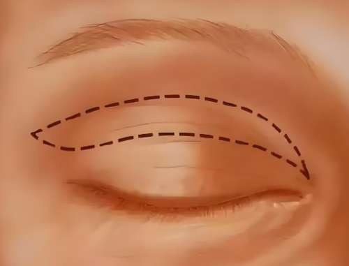 雙眼皮一個月和三個月的變化的描述怎么樣？趕緊來看看案例詳情