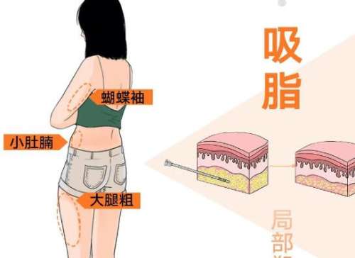 曹衛(wèi)剛吸脂多少錢？費用明細，醫(yī)生信息速看，看完不踩坑