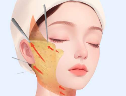美容拉皮術(shù)多少錢？費(fèi)用大公開啦