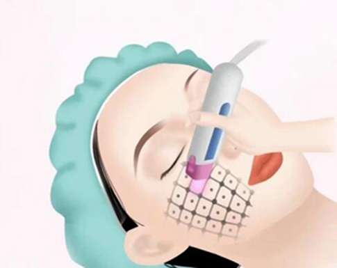 熱瑪吉有什么效果和副作用？看看恢復情況如何？