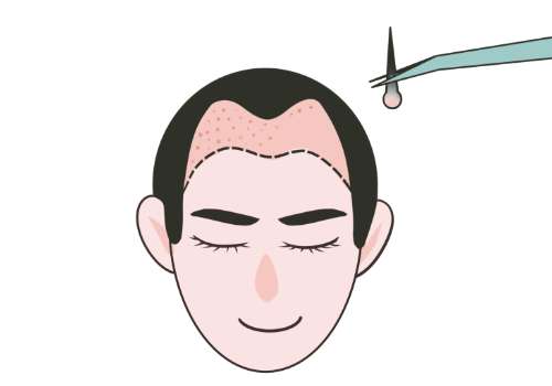 2025宜興有沒有植發(fā)醫(yī)院?人民醫(yī)院、華星等植發(fā)水平很高!