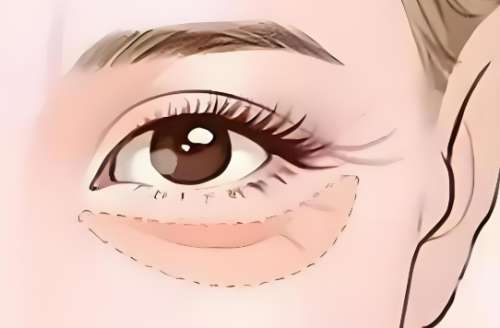 眼袋是怎樣產(chǎn)生的,如何消除？速來看看解決方式一覽