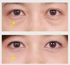 寧波祛眼袋醫(yī)院大揭秘：哪家好？排名靠前的五家醫(yī)院全攻略