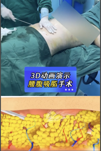 武漢腰腹環(huán)吸脂哪家醫(yī)院好？今天好好扒一扒！