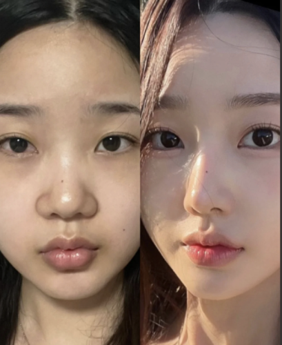 縮小鼻翼多少錢？為你講透價格那些事兒