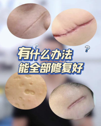 蘭州疤痕修復(fù)哪家醫(yī)院好點(diǎn)？