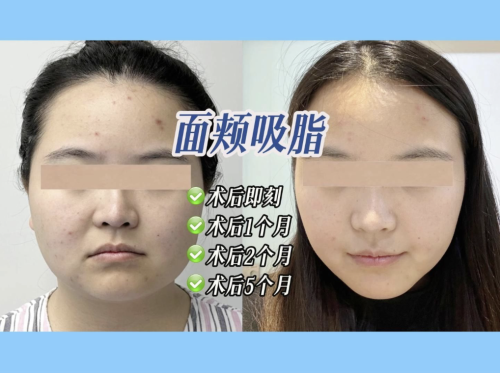 瘦臉面部吸脂術(shù)要多少錢一次？揭開價格秘密！