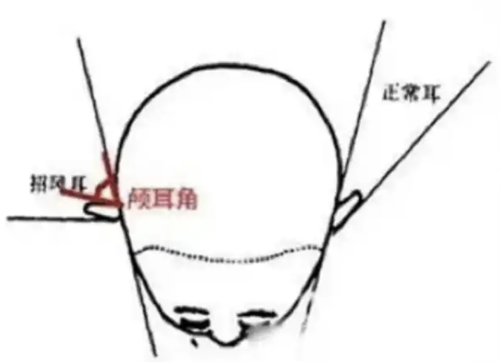 顱耳角可以調(diào)節(jié)嗎？重塑攻略來支招