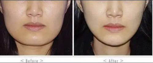 北京圣嘉新張笑天磨骨怎么樣？重塑臉型的 “雕刻大師”