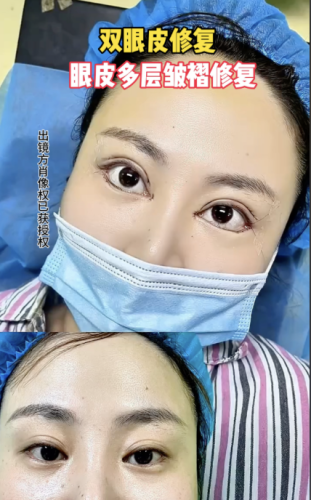 長沙雙眼皮修復(fù)哪家醫(yī)院好？今天好好盤一盤