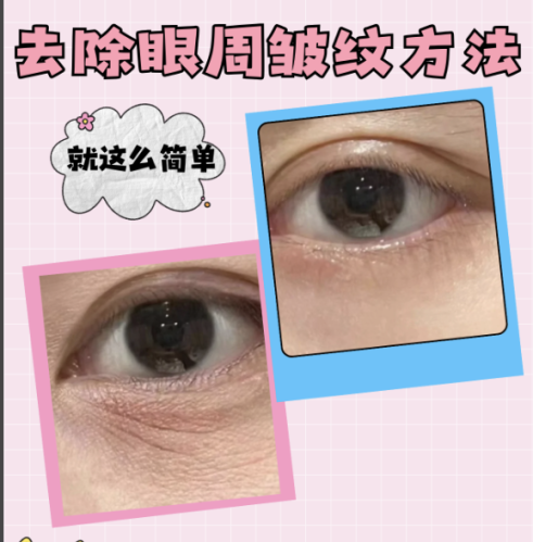 怎么去眼部皺紋？實(shí)用妙招全攻略