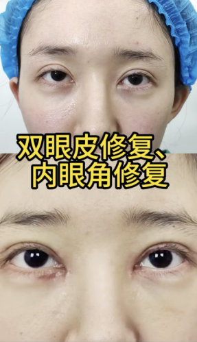 上海張詩若修復雙眼皮內眼角怎么樣？眼部修復實力派大揭秘