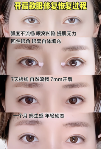 長沙雙眼皮修復(fù)醫(yī)生推薦：拯救 “翻車” 雙眼的寶藏醫(yī)師