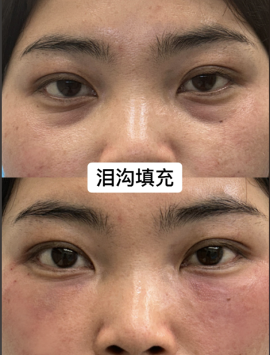 淚溝填充可以維持多久？揭秘美麗續(xù)航時間