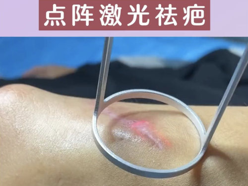 廣州曙光醫(yī)院去疤痕效果好嗎？實(shí)測(cè)疤痕 “橡皮擦” 是真是假？