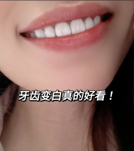 怎樣使牙齒變白？亮白全攻略，解鎖自信笑容的密碼