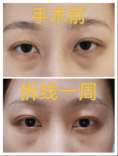 北京哪里做眼袋比較好的醫(yī)院？優(yōu)質(zhì)醫(yī)院大盤點(diǎn)