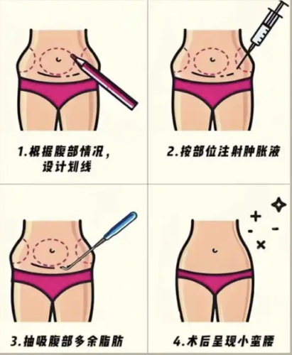 武漢腰腹環(huán)吸做的好的醫(yī)生，以下三位可得牢牢記住