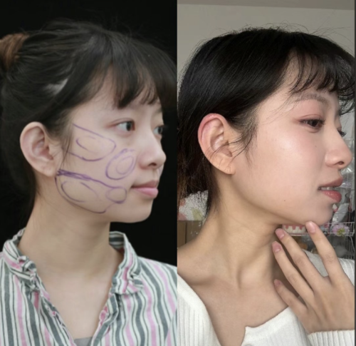 馬梅生面部吸脂多少錢?。縼砜凑鎸嵤召M標準