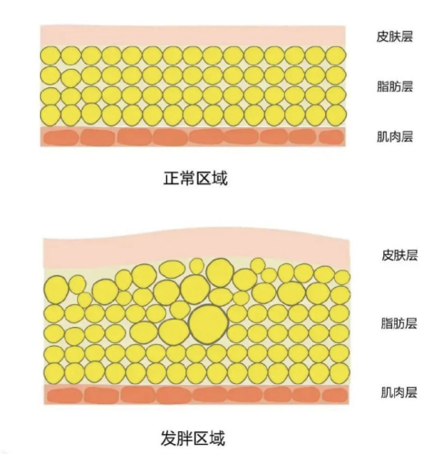 產(chǎn)前吸脂好還是產(chǎn)后吸脂好？怎么選才明智？