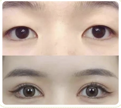 蘇州哪家整形醫(yī)院做雙眼皮好？熱門醫(yī)院大測評