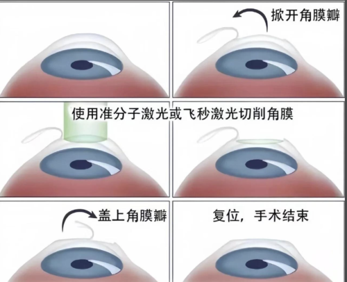 深圳哪里可以做近視眼手術？摘鏡指南送給你