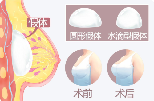 南京假體隆胸哪家醫(yī)院好？假體隆胸體驗(yàn)實(shí)錄