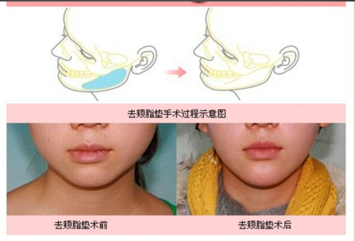 去頰脂墊后注意事項(xiàng)：守住小臉顏值的 “通關(guān)秘籍”