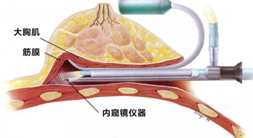 南京假體隆胸哪家好？?jī)?nèi)窺鏡隆胸好醫(yī)院私藏