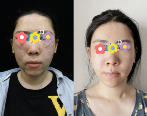 馬梅生面部吸脂怎么樣？把臉蛋的 “多余肉肉” 請出門的高手