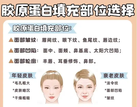 骨膠原填充面部?jī)r(jià)格多少？臉蛋營(yíng)養(yǎng)得花在點(diǎn)子上