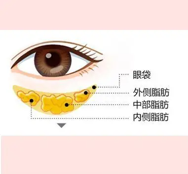 去眼袋整容醫(yī)院掛什么科？給 “熊貓眼” 找對(duì) “主治醫(yī)生”