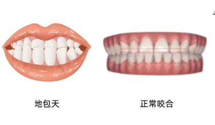 地包天輕微與嚴重圖片，影響顏值可一定要重視